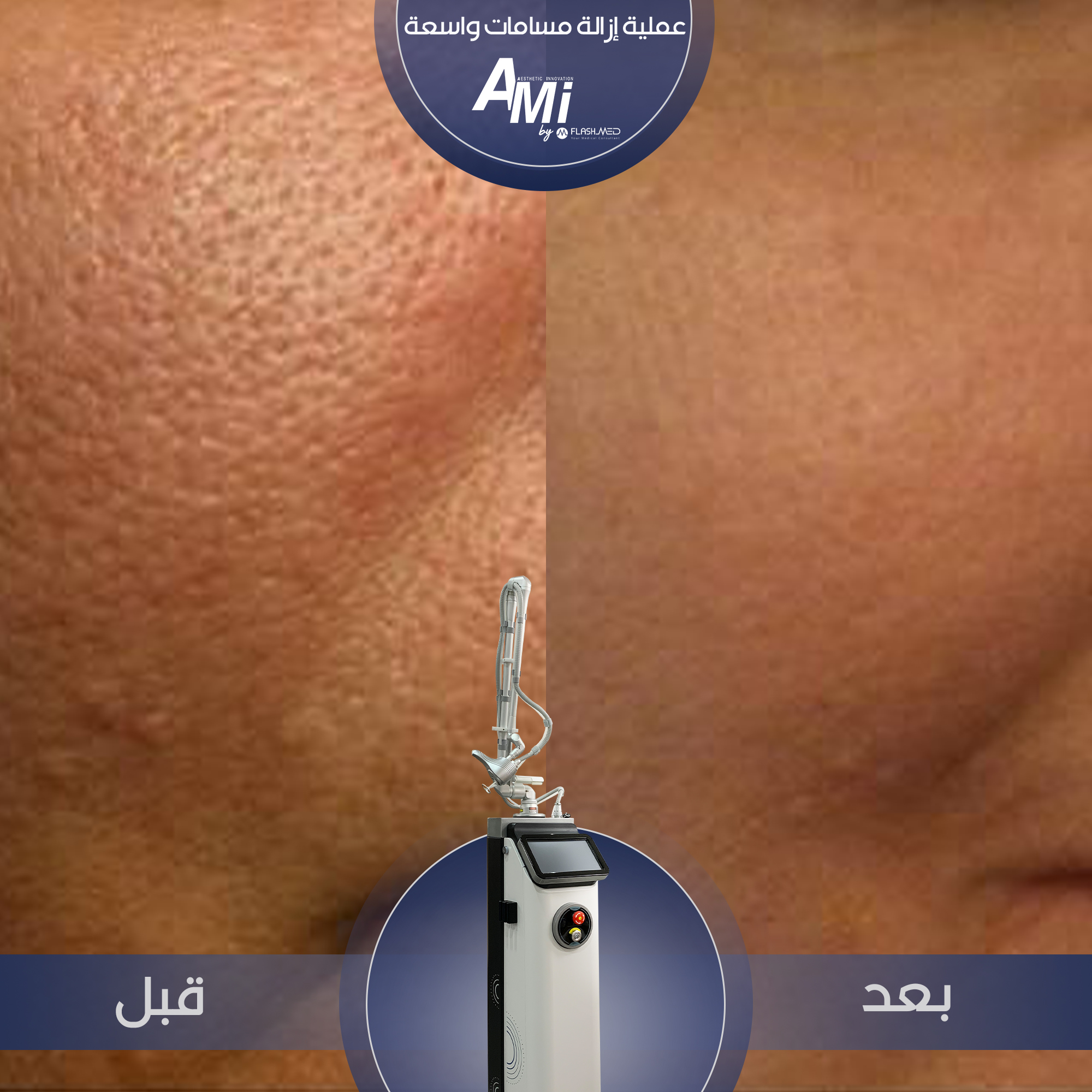 "AMI-CO2 laser device effectively removes pigmentation, improves skin texture, and restores even tone."