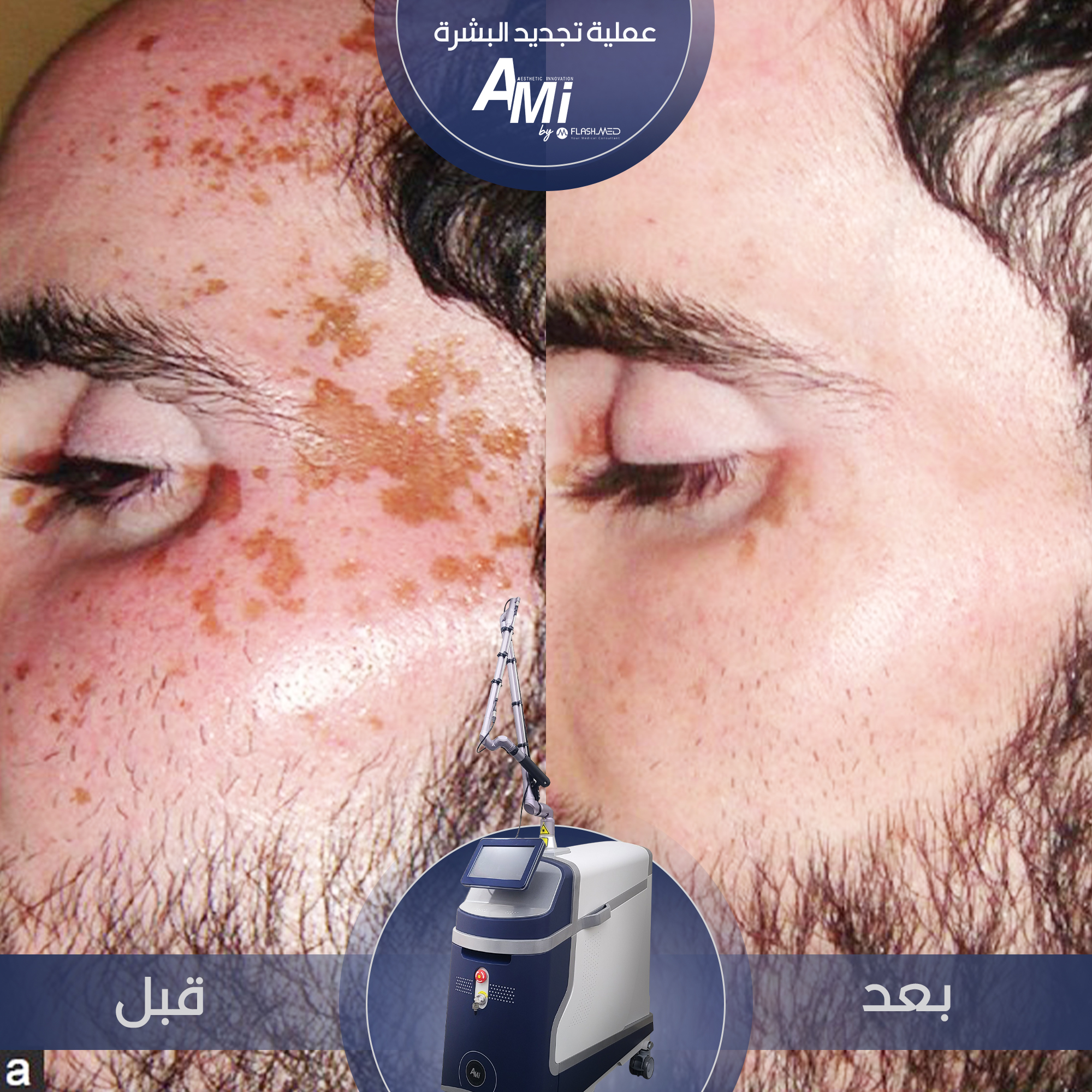 "Before and after results of AMI-Q laser treatment for skin tone enhancement, highlighting smooth and even skin."