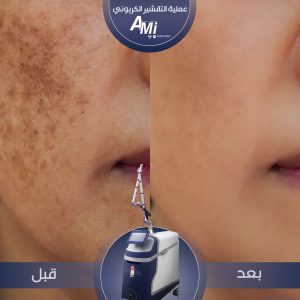 "Before and after results of skin tone correction using AMI-Q laser, showcasing even and radiant skin."