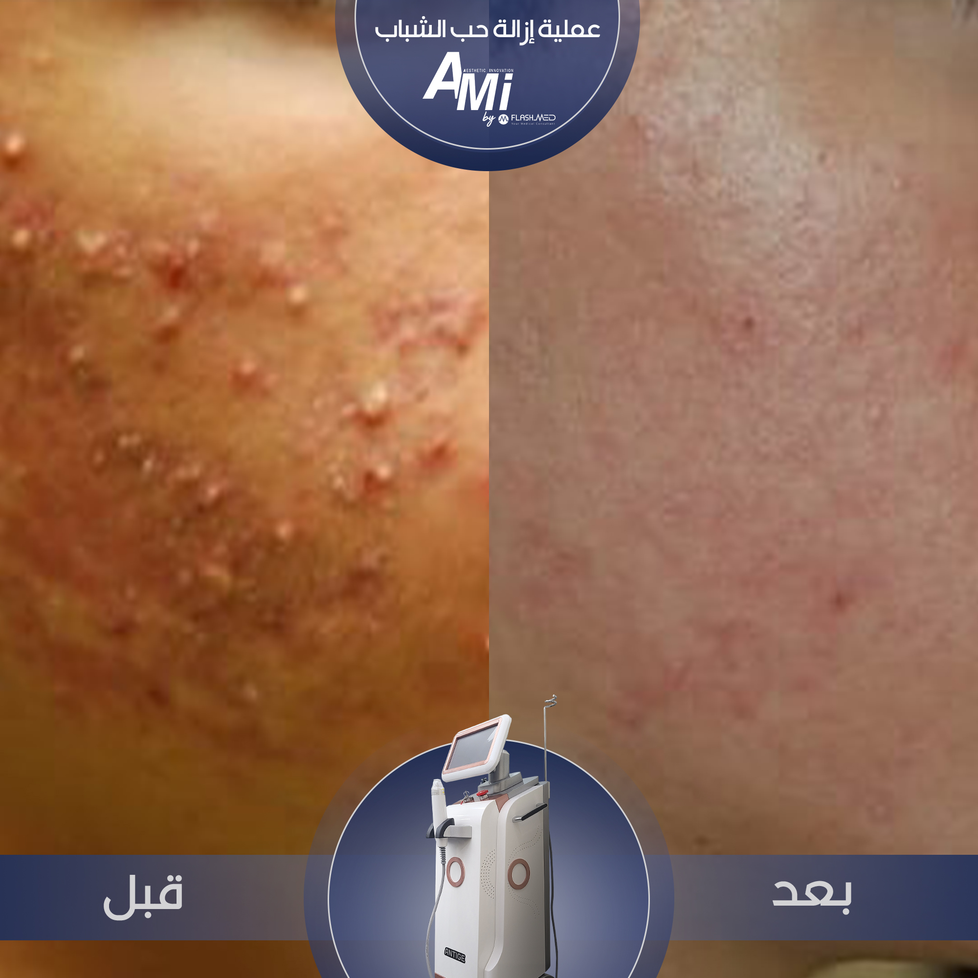 "Effective acne treatment using AMI-RF microneedling technology, targeting scars and improving skin texture."