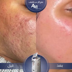 Before and after acne scar treatment using the AMI-RF device, showing smoother skin texture.