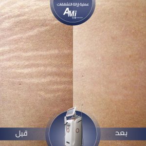 Before and after stretch mark treatment using the AMI-RF device, showing reduced marks and smoother skin