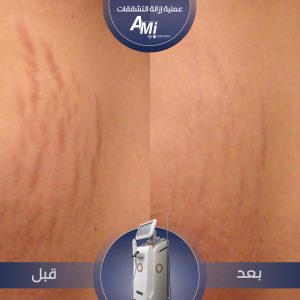 Before and after fine line and stretch mark treatment using the AMI-RF device, showing firmer and smoother skin